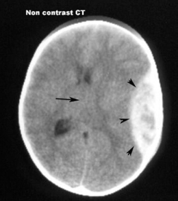 EDH pada CT Scan kepala