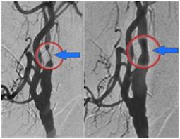 Penyempitan pembuluh darah sebagai pencetus serangan stroke. Pada gambar di sebalh kanan tampak intervensi dilakukan dengan pemasangan stent untuk melebarkan saluran pembuluh darah